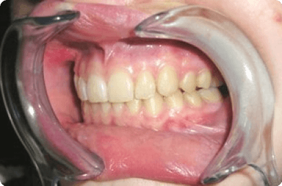 Коррекция прикуса