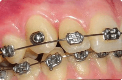 Коррекция прикуса