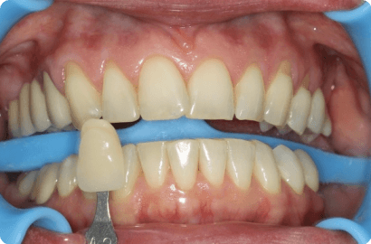 Отбеливание зубов