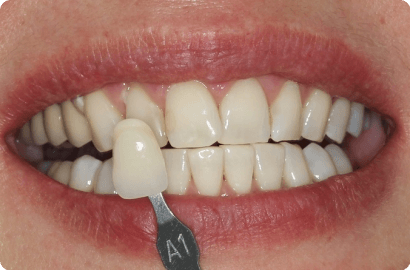 Отбеливание зубов