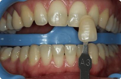 Отбеливание зубов Beyond Polus