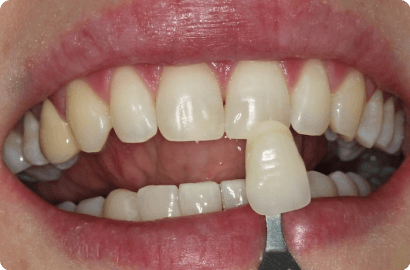 Отбеливание зубов Beyond Polus