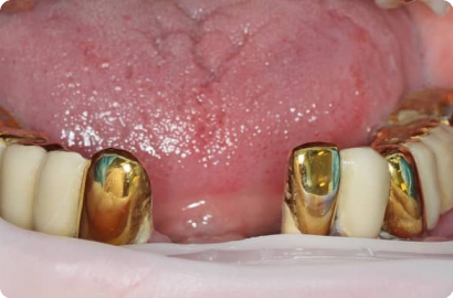 Имплантация все на 4 