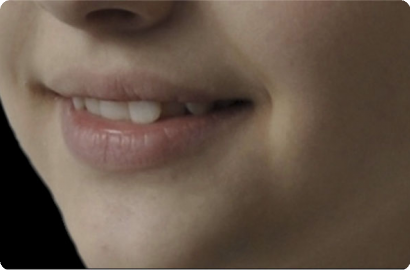 Лечение на элайнерах