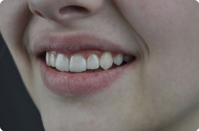 Лечение на элайнерах