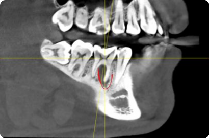 Удаление кисты без удаления зуба