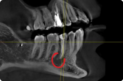 Эндодонтическое лечение кисты