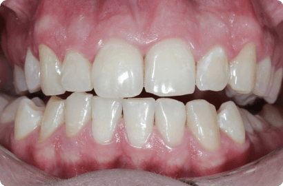 отбеливание зубов