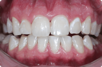 отбеливание зубов