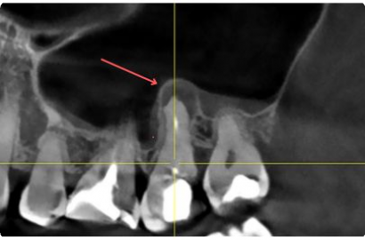 Лечение кисты зуба до и после