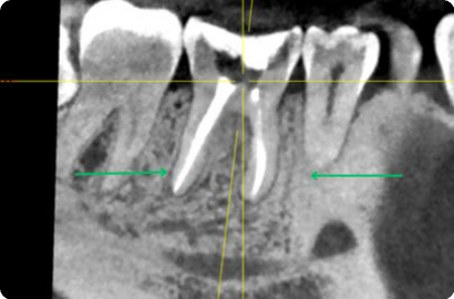 Удаление кисты без удаления зуба