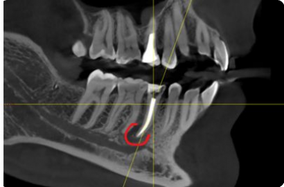 Эндодонтическое лечение кисты