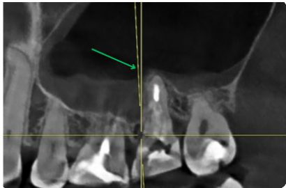 Лечение кисты зуба до и после