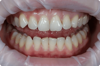 Лечение кариеса