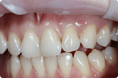 Лечение кариеса