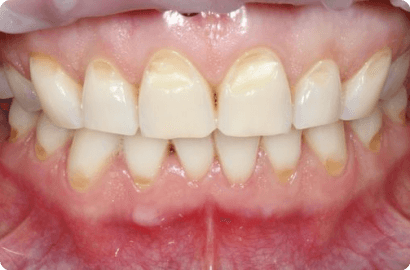 Реставрация клиновидных дефектов