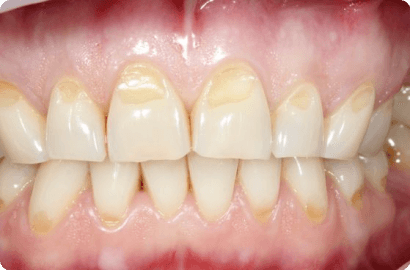 Реставрация клиновидных дефектов