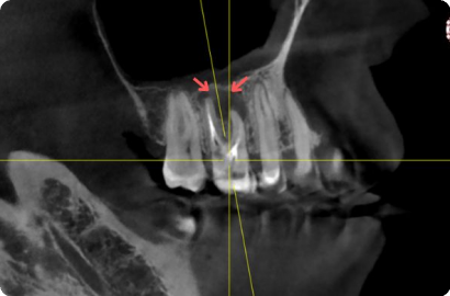 Гайморит с  кистой зуба