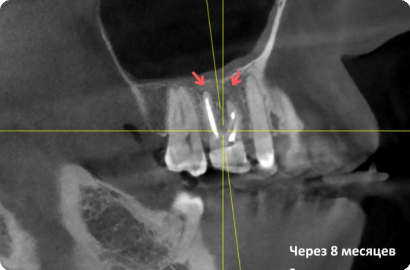 Гайморит с  кистой зуба
