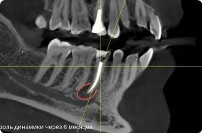 Лечение зуба с кистой
