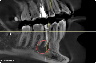 Лечение зуба с кистой