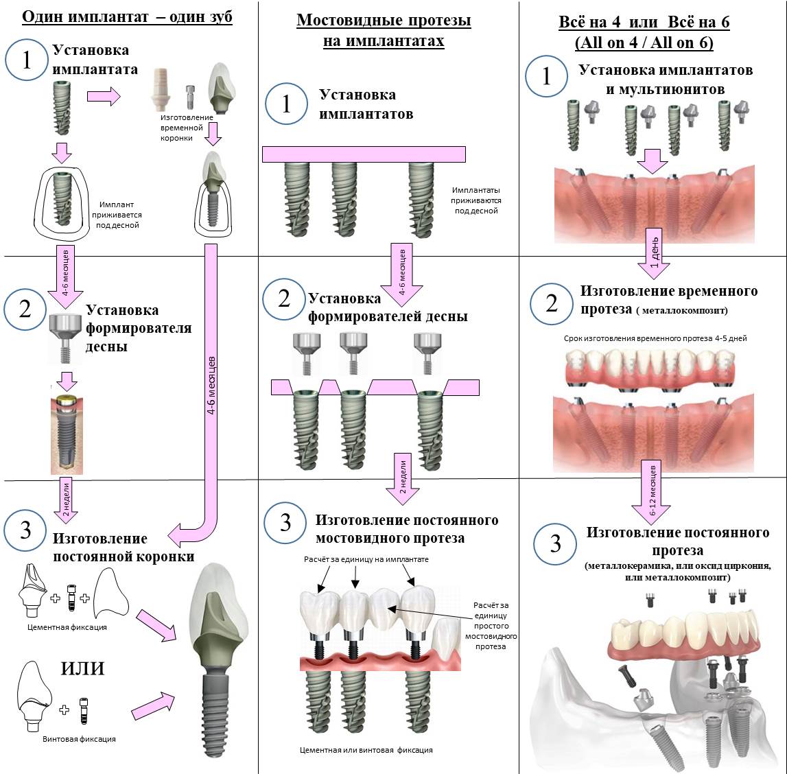 Схема установки стоматологических имплантов